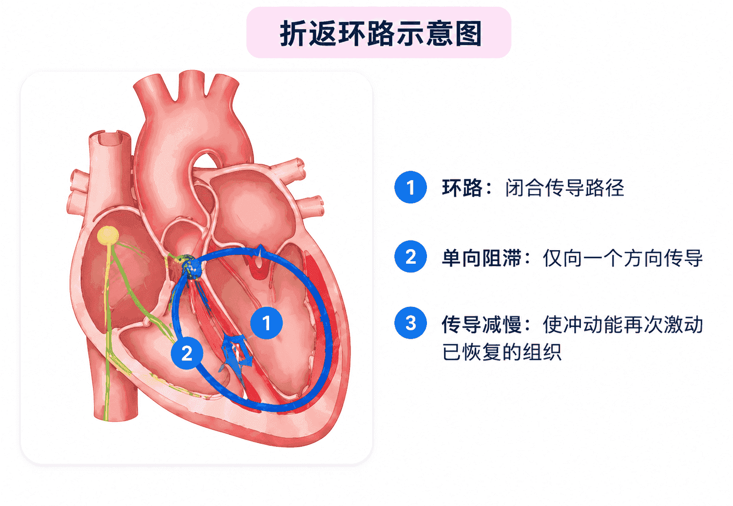 折返形成三要素示意图：环形路径、单向阻滞、传导减慢