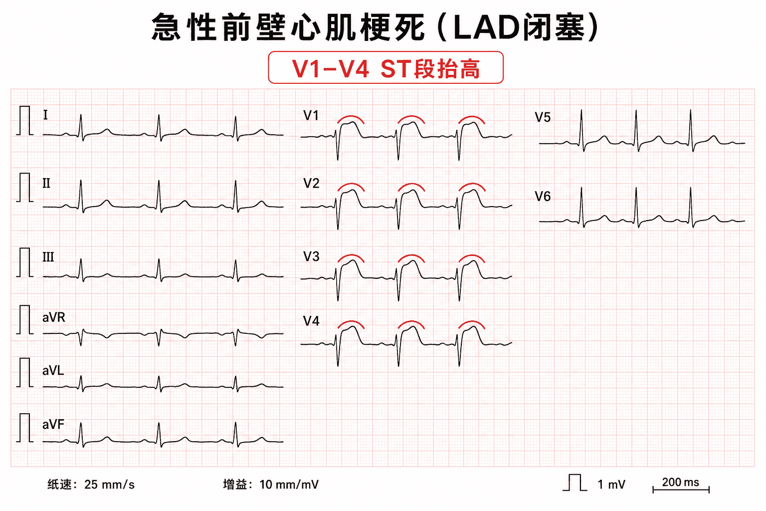 案例1:急性前壁心肌梗死,V1-V4 ST段抬高
