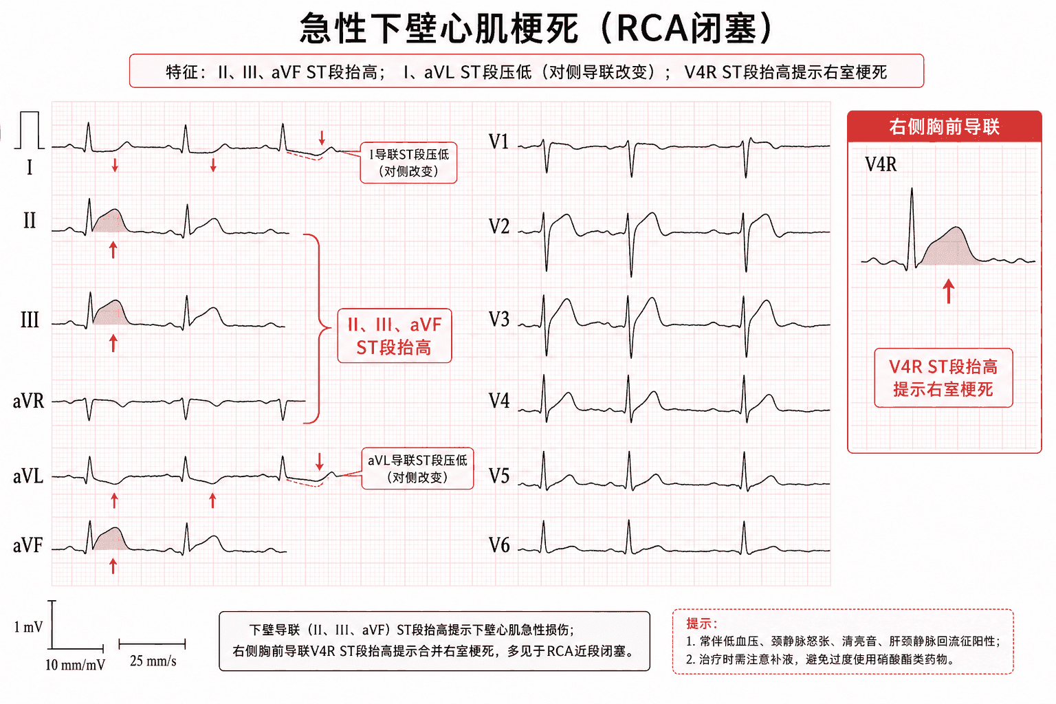 案例2:急性下壁心肌梗死伴右室受累,II、III、aVF及V4R ST段抬高