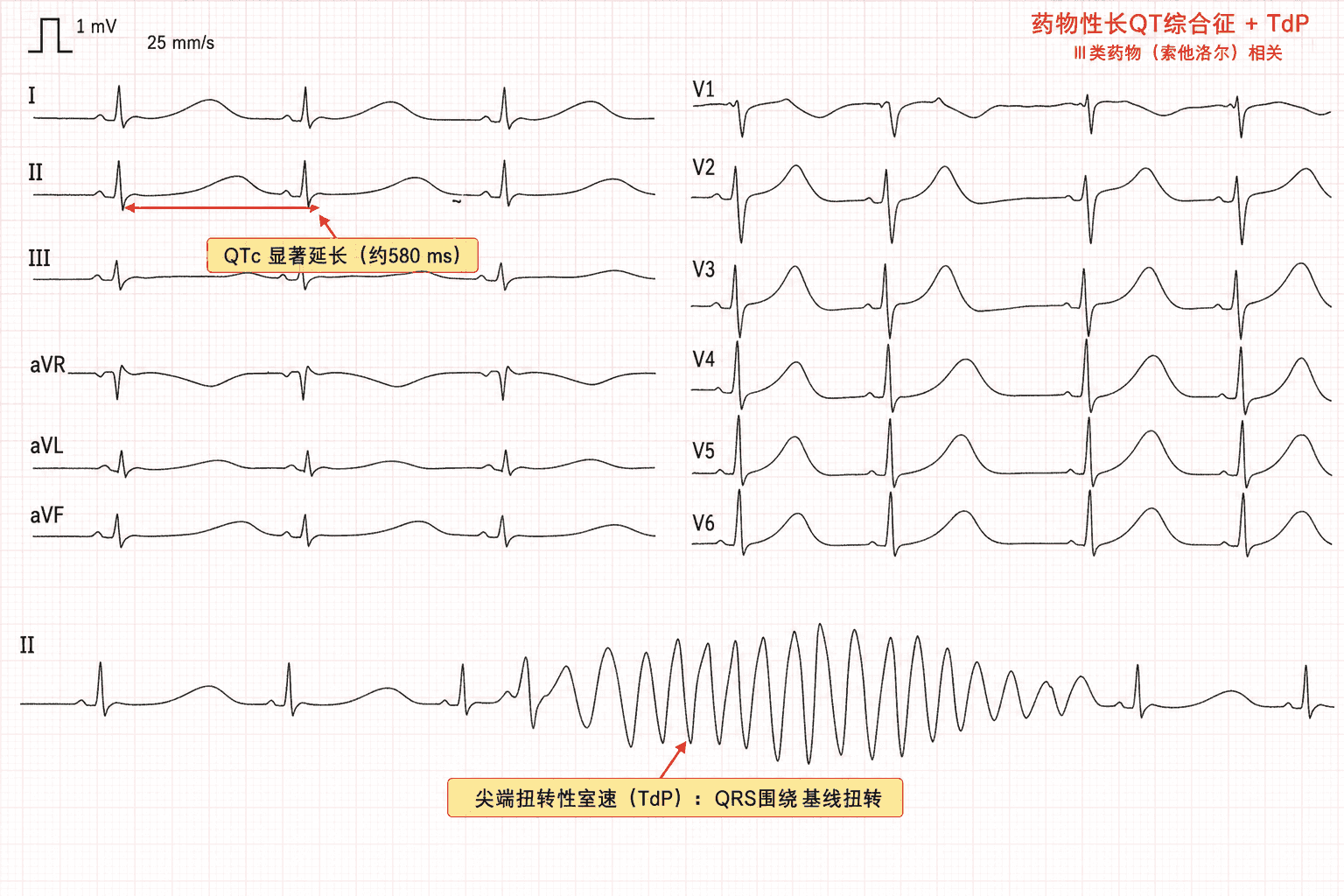 案例1 心电图:索他洛尔相关药物性长QT综合征,QTc 约 580ms,并发 QRS 围绕基线扭转的尖端扭转型室速