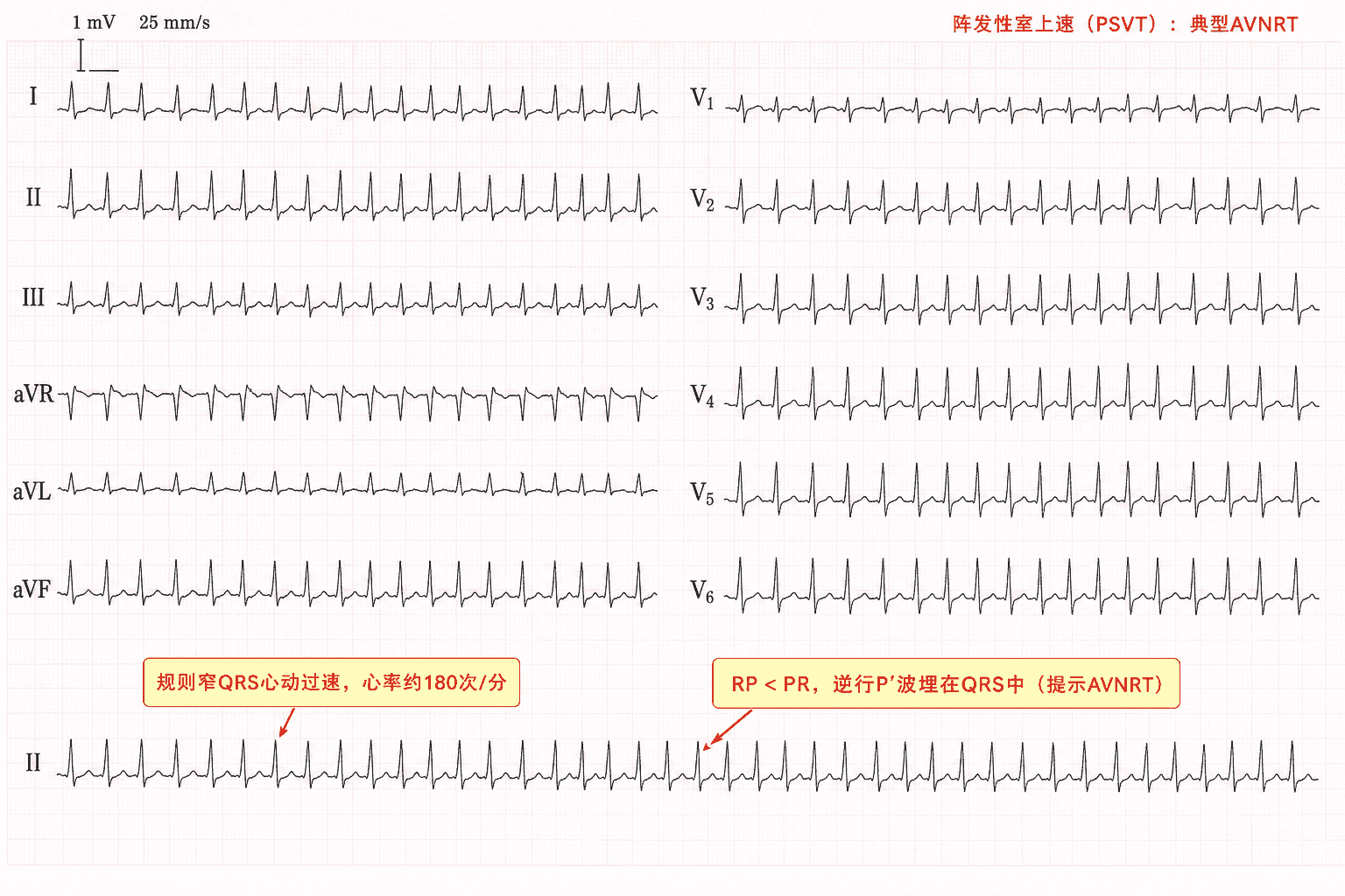 案例3 心电图:阵发性室上速(典型 AVNRT),规则窄 QRS 心动过速、心率约 180 次/分,RP 间期短于 PR,逆行 P' 波埋在 QRS 中