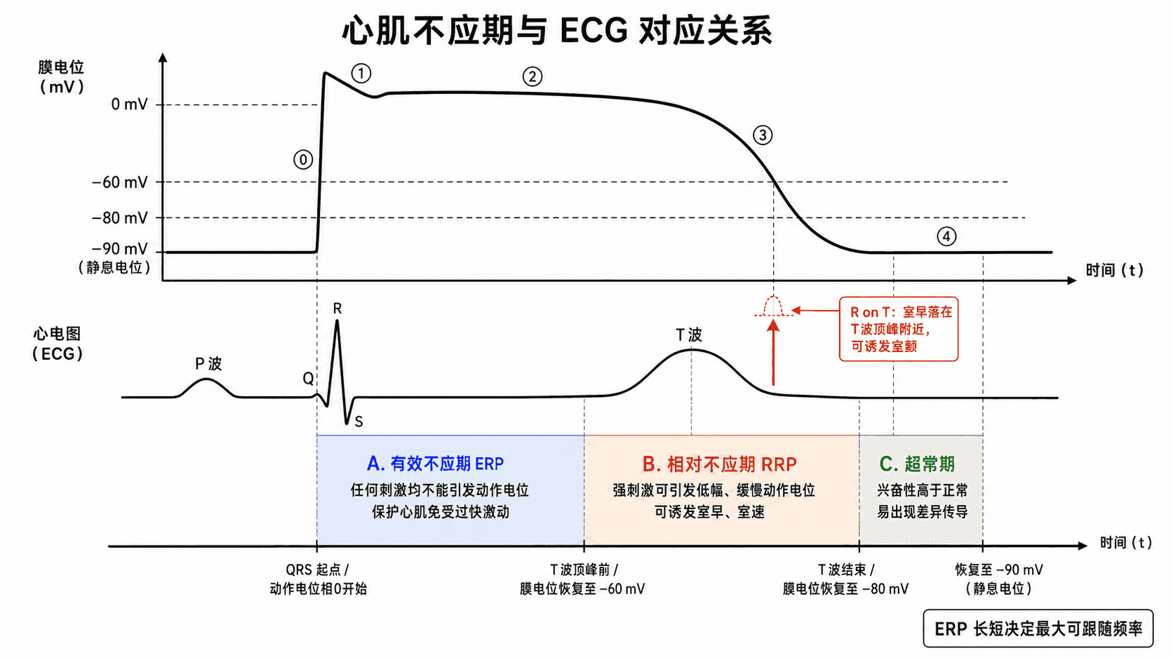 心肌不应期与心电图的时间对应:有效不应期为 QRS 起点至 T 波顶峰前,相对不应期至 T 波结束,其后为超常期;落在 T 波顶峰附近的室早即 R on T