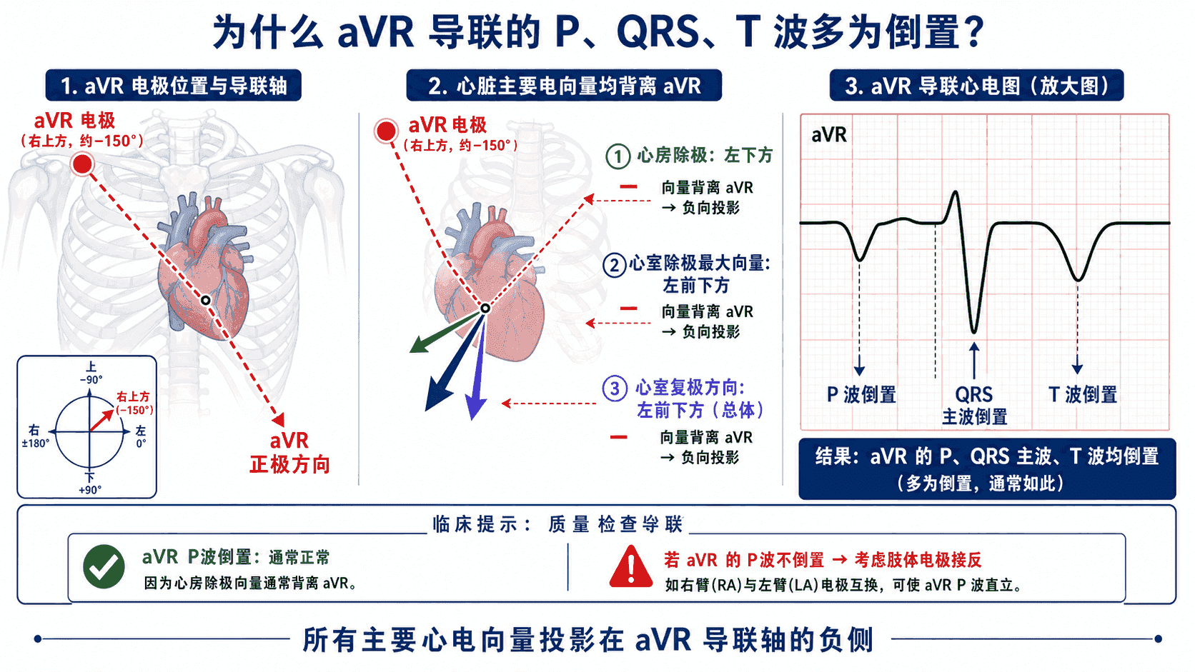 aVR 导联三个主要向量均投影在负侧:电极位于右上方约 −150°,P 波、QRS 主波与 T 波因此均倒置,可用作肢体电极接反的质量检查