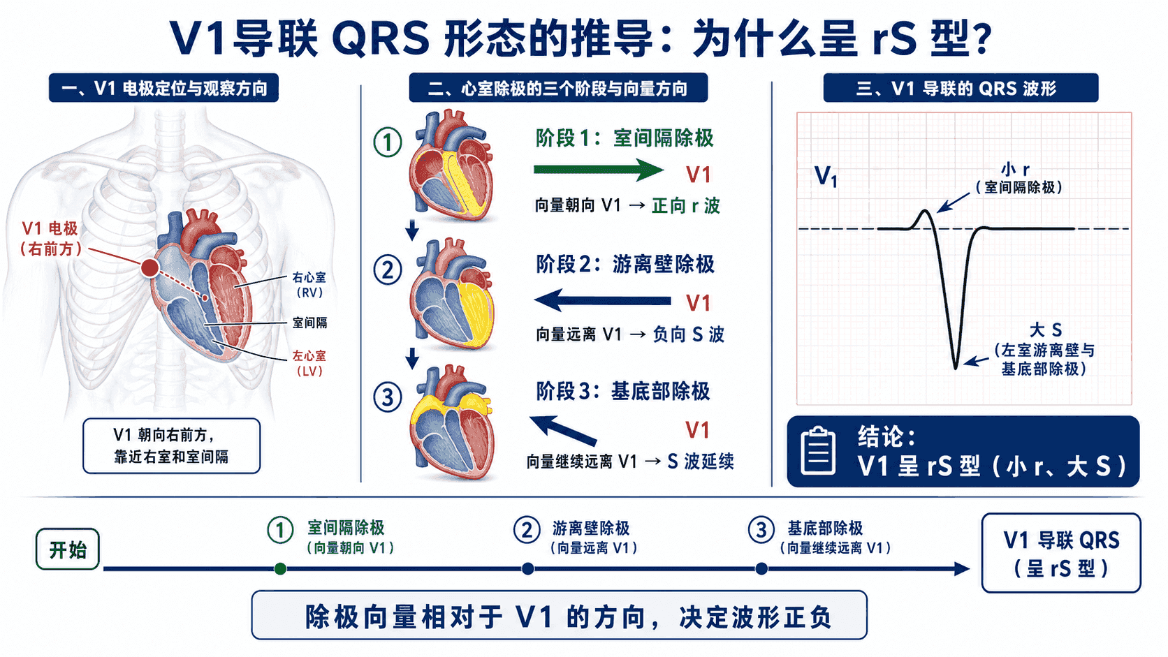 V1 呈 rS 型的向量推导:室间隔除极朝向 V1 形成小 r,左室游离壁与基底部除极背离 V1 形成大 S