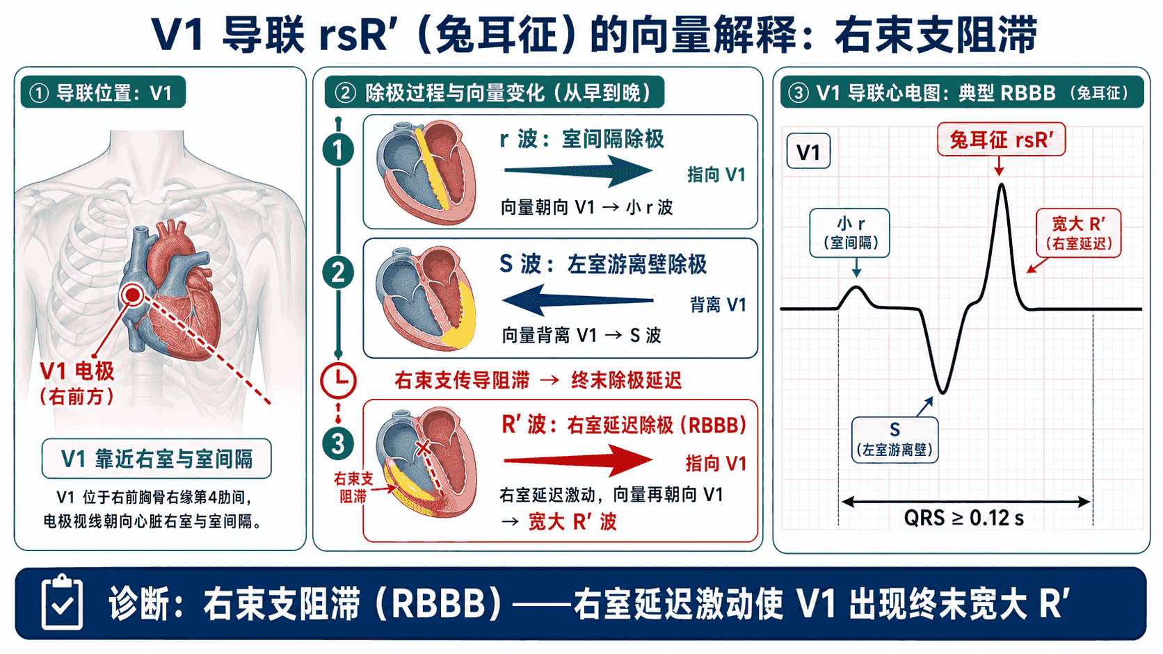 V1 导联 rsR' 兔耳征的向量解释:小 r 来自室间隔除极,S 来自左室游离壁,宽大 R' 来自右束支阻滞时右室的延迟激动,QRS 时限 ≥ 0.12s