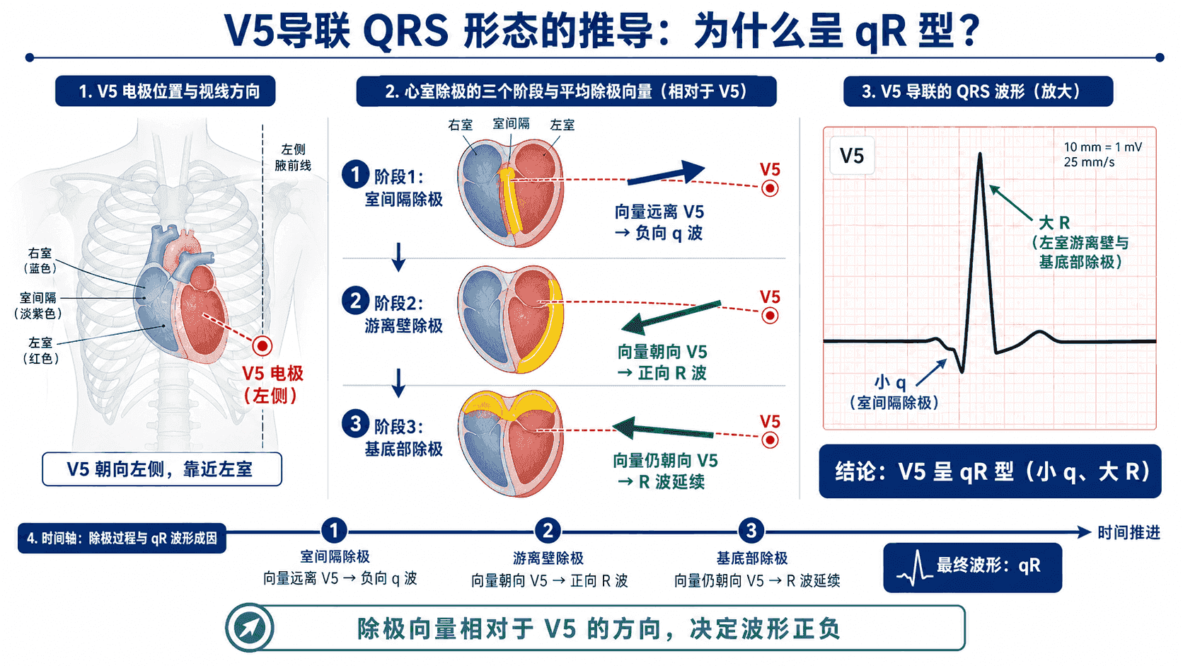 V5 呈 qR 型的向量推导:室间隔除极背离 V5 形成小 q,左室游离壁与基底部除极朝向 V5 形成大 R