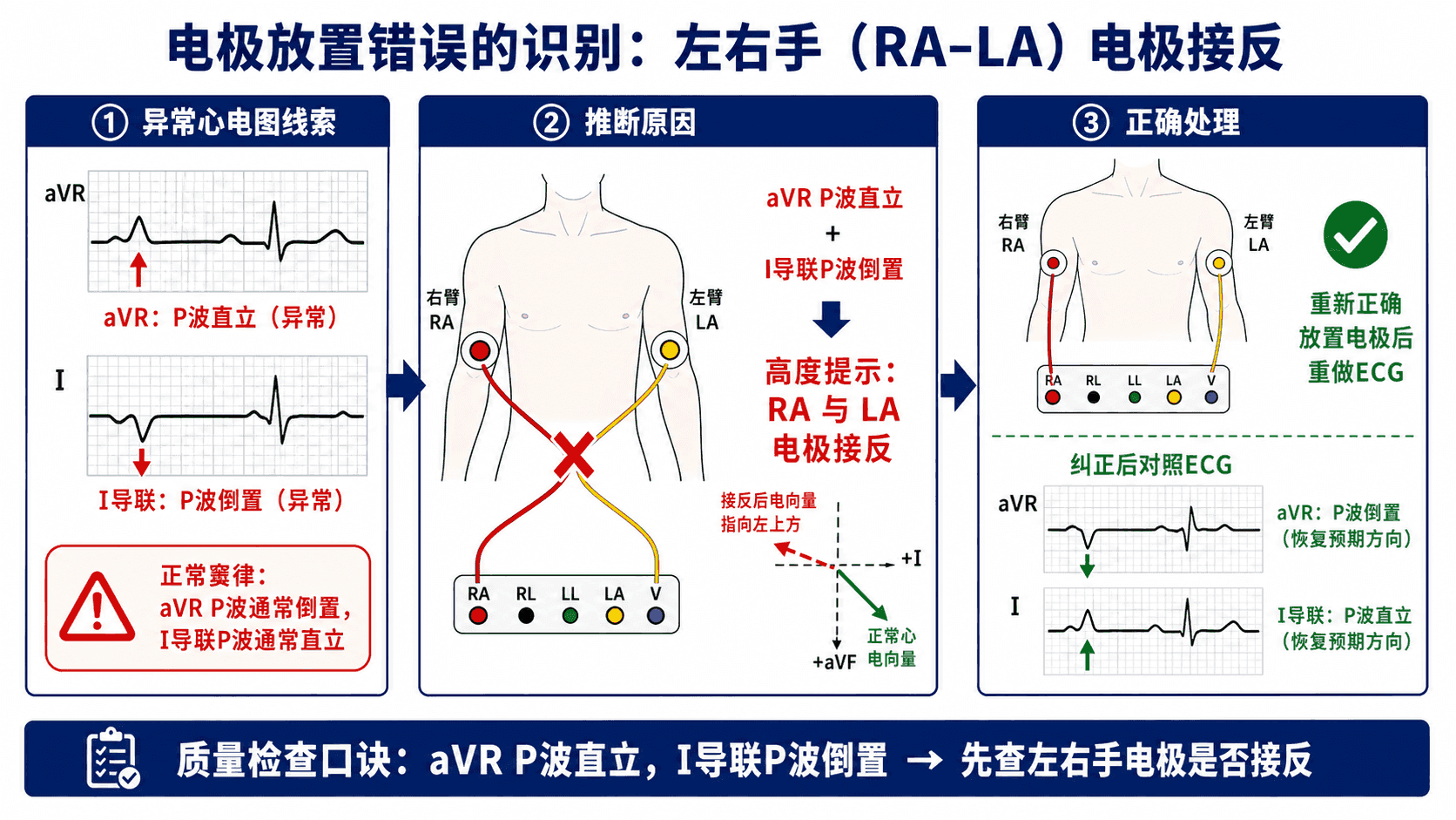 肢体导联错接示例