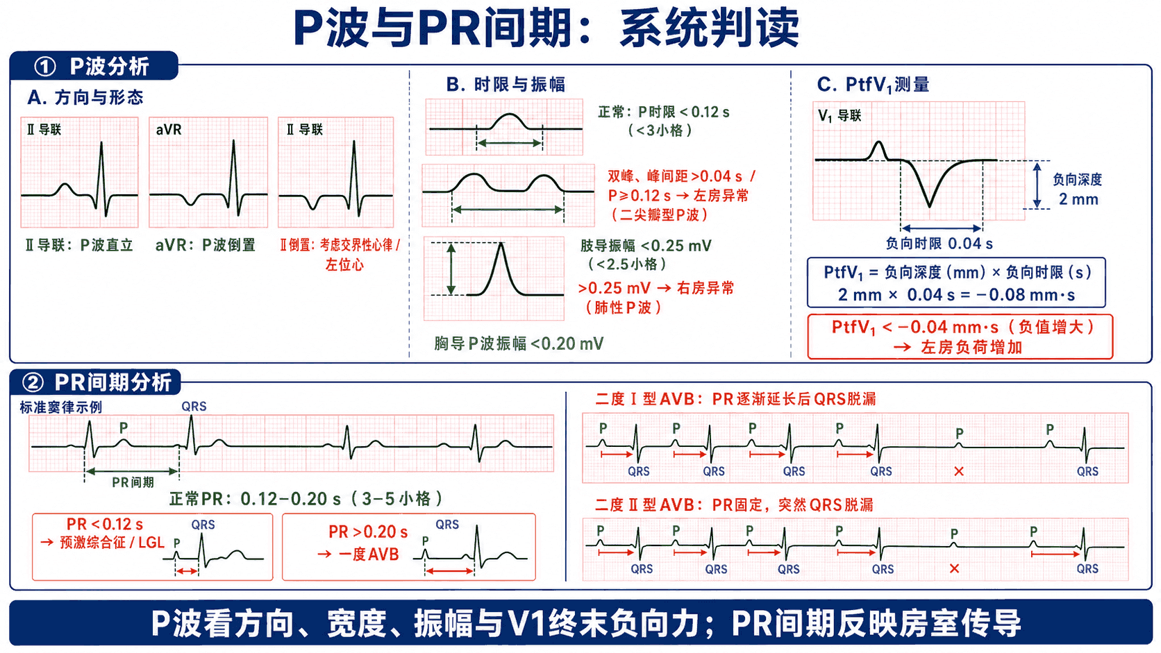 P波与PR间期系统判读:方向、时限、振幅与 PtfV₁ 测量,以及 PR 间期正常范围与二度Ⅰ型/Ⅱ型房室传导阻滞的差别